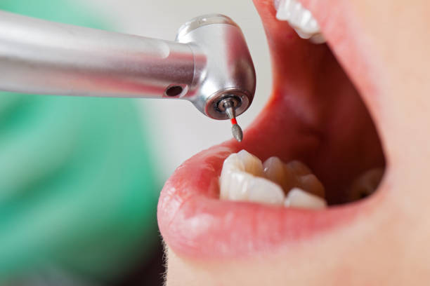 Best Emergency Root Canal Treatment in Clovis, CA